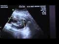 4D Ultrasound 20 Weeks finding out gender 4D Ultrasound 20 Weeks finding out gender