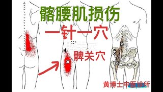 髂腰肌损伤 | 剧烈腰痛 | 弯腰不能 | 一针一穴 立竿见影 | 奥克兰中医诊所