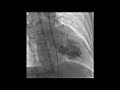 cath case how will you grade mitral regurgitation mr on ventriculogram cardiology heart