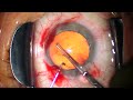 2024 06 19 122707 LAL+ Conductive Keratoplasty