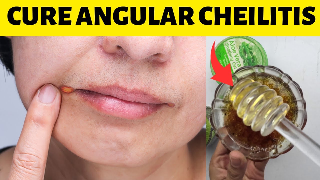 How To Get Rid Of Angular Cheilitis Overnight In Corner Of Mouth - YouTube