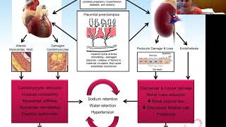 Pregnancy Induced Hypertension Part 1 | Health4TheWorld Academy