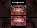 Underbite braces transformation #braces #orthodontist #dentist #bracket