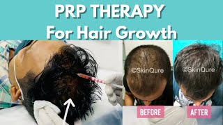 📍PRP THERAPY FOR HAIR LOSS #shorts #prp