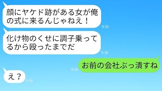 顔に火傷の跡がある私を見下し、結婚式で突然腹を殴った妹の婚約者「お前みたいな化け物は消えろw」→性格の悪いクズ男に私の本当の正体を知らせた時の反応がwww