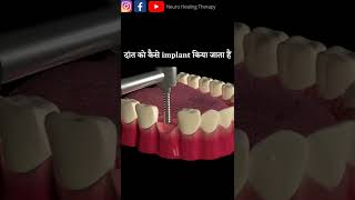 नकली दाँत को कैसे फिट करते हैं #shorts #teeth