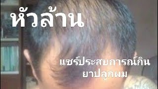 แชร์ประสบการณ์หัวล้าน และวิธีการรักษาแบบทานยา ปลูกผม