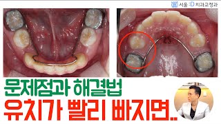 유치가 일찍 빠지면 어떻게 될까요? 문제점과 해결방법