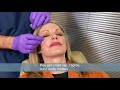 Botox® Demonstration Corrugators, Forehead & Crowsfeet  Ramsey Choucair, MD.  Ph 214-389-9797