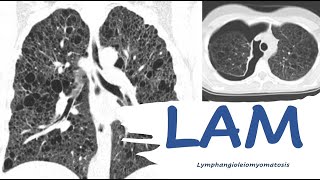 Unveiling LAM: A Journey into the Rarest Lung Disease (LYMPHANGIOLEIOMYOMATOSIS)