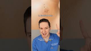 Dermatologist explains how to tell if you have a wart! #wart #verruca #whatsonmyskin #plantarwart