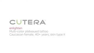 Cutera Enlighten Laser - Tattoo Removal