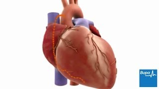 How coronary artery bypass graft (CABG) surgery is carried out