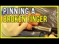 Fixing A Finger Fracture With Pins