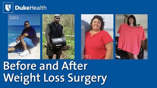 Before and After Weight Loss Surgery | Duke Health