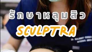 SCULPTRA รักษาหลุมสิว