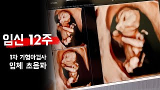 임신 12주 임산부 / 1차 기형아검사 / 입체초음파