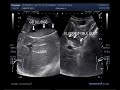 Ultrasound Video showing Gall bladder sludge also called Biliary sludge.