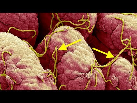 Home Remedies To Get Rid Of Pinworms Forever !! Home Remedies To Get Rid Of Pinworms Forever !!