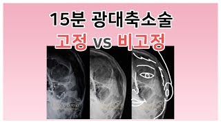 광대축소술 - 고정 vs 비고정 (X-ray, 치과)(reduction malarplasty/cheekbone reduction/quick reduction)