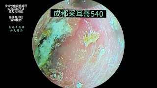 Treating moldy cerumen on the ear canal and eardrum ｜ 540