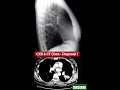 diagnosis cxr u0026 ct chest practice case 214 practical case radiology