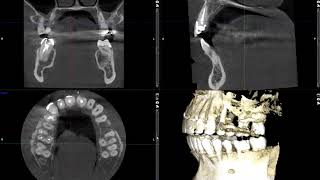 Buccal Exostosis