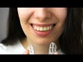 what to know before your first braces appointment 4 tips for your consultation