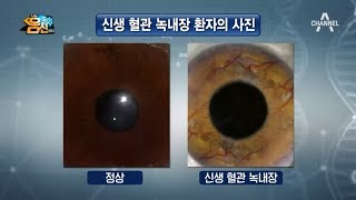 녹내장과 뇌경색까지 부르는 '눈 중풍' l 나는 몸신이다 202회