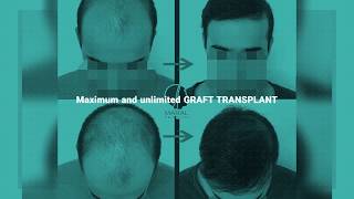 Hair Transplantation | Maral Hair Klinik