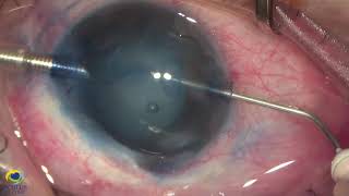 UT-DSAEK and phacoemulsification in an eye with intumescent white cataract and bullous keratopathy