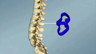 The treatment of spine fracture and tumors with the method of vertebroplasty