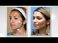 y lift ® 2016 karina instant non surgical facelift