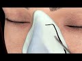 Septo-Rhinoplasty 3D Protocol - Piezotome M+