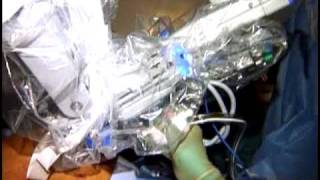 Robotic Prostatectomy Surgery using da Vinci Robot - Dr. Sanjay Razdan