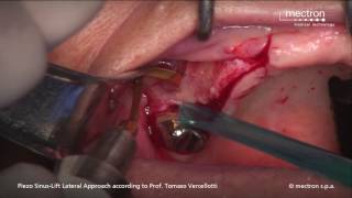 PIEZOSURGERY - Prof. Tomaso Vercellotti - Sinus lift with lateral approach