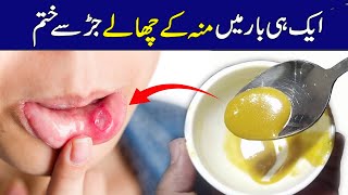 Muh Ke Chalo Ka Ilaj | Mouth Blisters Causes and Treatment |منہ کے چھالوں کا فوری علاج