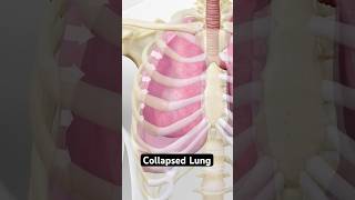 Collapsed lung explained (3D Animation)