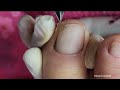 unhas dos pés - cutículas super ressecadas / use sempre um óleo com amolecedor !!!