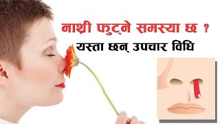 नाथ्री फुट्ने समस्या छ ? यस्ता छन् उपचार विधि | Nepali Health Tips