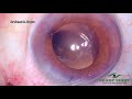 Management Of  tilted & decentered IOL in a fibrosed capsule @sharp sight  by Dr. Kamal Kapur