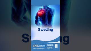 Fatigue, swelling, or joint pain? Early arthritis signs matter! Seek help today. #rheumatoid