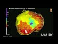 pr2024 ablation of ventricular arrhythmias 2 april 21 2024