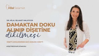 Diş eti Çekilmesinde Bağ Dokusu Grefti Tedavisi Nedir? I Damaktan Doku Alınıp Diş etine Dikilmesi