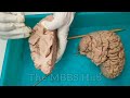 INTERNAL CAPSULE OF BRAIN | BRAIN DISSECTION 🧠 | DISSECTION #mbbs #neet #nursing #aiims #viral