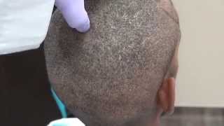 Hair Transplant FUE Donor Scar 2000 Grafts 1 Year Post-Op Dr. Diep Bay Area www.mhtaclinic.com