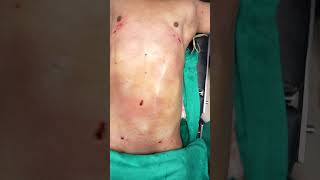 360 Abdominal Liposuction #shortvideo #shots #dezireclinicindia