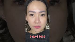 Filler Bibir di EternaMoore ‼️ Hasil Natural dan Proporsional 🥰