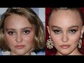 Has Plastic Surgery Prematurely Aged Lily Rose Depp