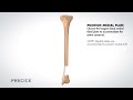 PRECICE Plate Assisted Bone Transport Animation